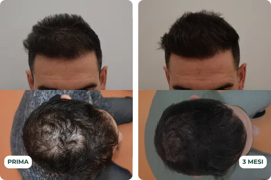 Alopecia: Come combatterla in modo naturale con soluzioni clinicamente testate e sicure