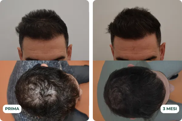 Alopecia: Come combatterla in modo naturale con soluzioni clinicamente testate e sicure